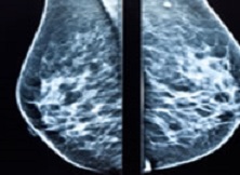 Digital Mamography service in Miami